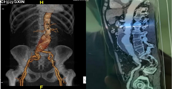 手术后专家简介黄任平教授,血管外科病区负责人医学博士,博士后,硕士