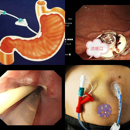 王立国副主任医师介绍,经皮内镜下胃造口术(peg)是指在内镜辅助下行胃