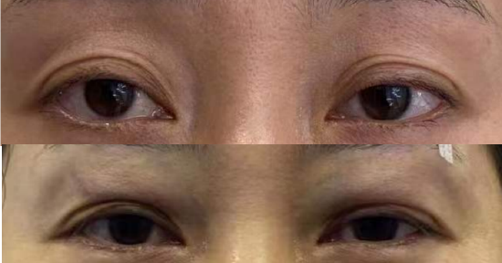 哈医大四院松北整形美容外科将自体脂肪变废为宝解决上眼窝凹陷的烦恼