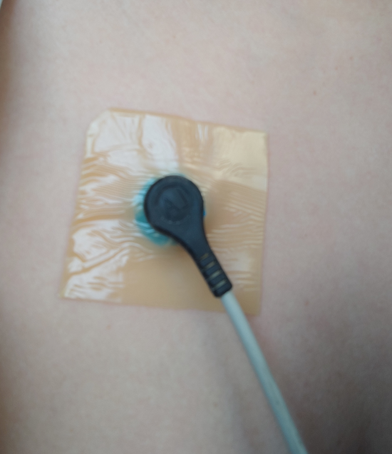 缓解过敏体质患者电极片过敏现象