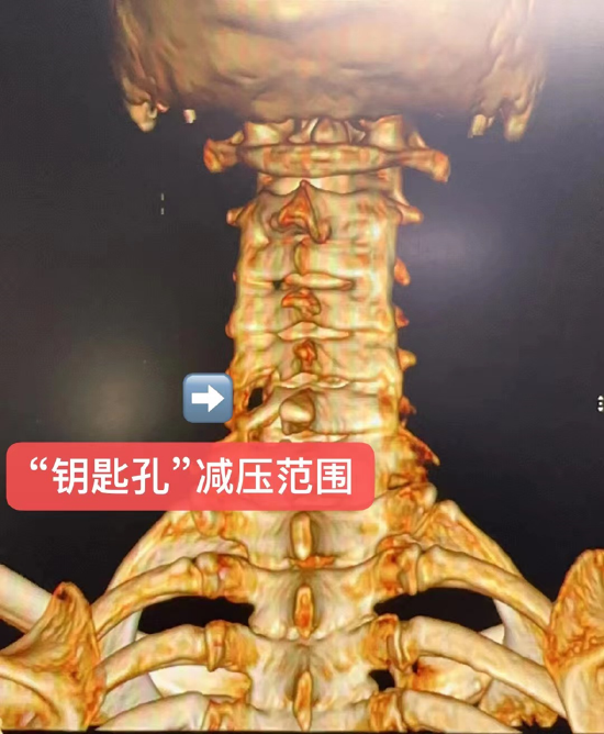 “钥匙孔”解决大难题 哈医大一院骨科祁全教授团队Keyhole微创治疗颈椎病_新浪黑龙江_新浪网