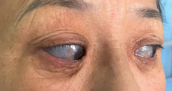 哈医大一院眼科三病房李志坚团队成功为脆骨蓝巩膜综合