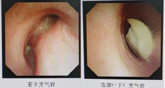哈医大一院群力院区呼吸介入团队成功为七旬老人取出气道异物化险为夷