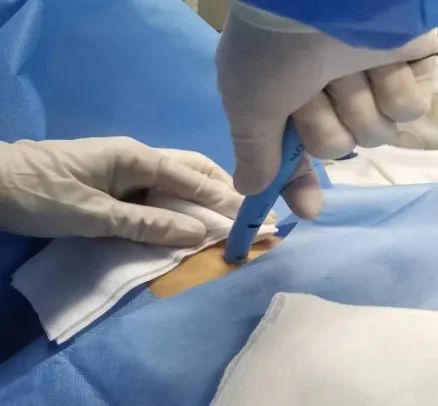 哈医大四院icu真正的迷你气切超声引导下经皮气管切开