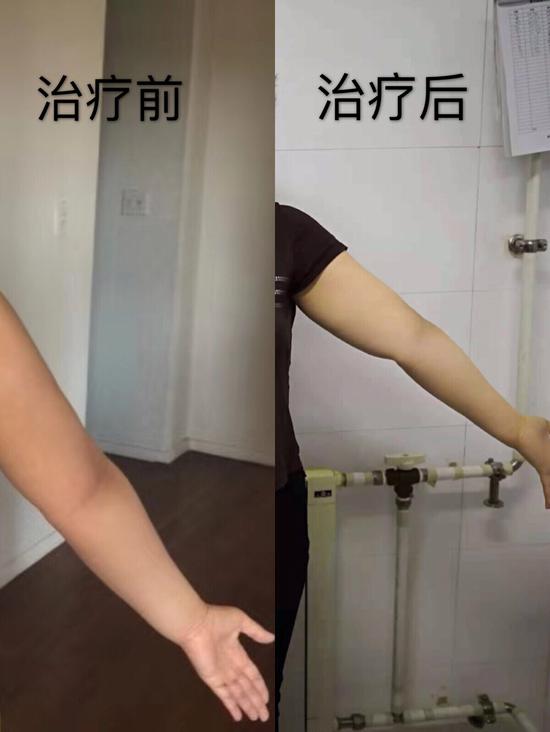 乳腺癌术后上肢水肿哈医大一院综合消肿治疗解患者困扰