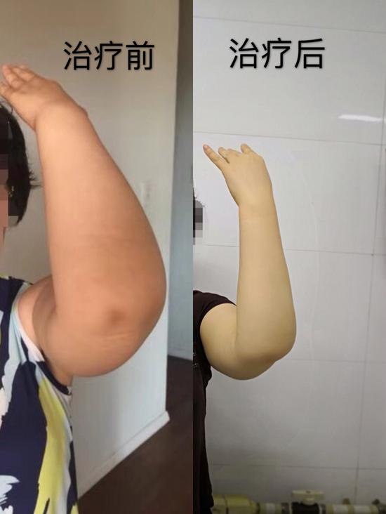 乳腺癌术后上肢水肿哈医大一院综合消肿治疗解患者困扰