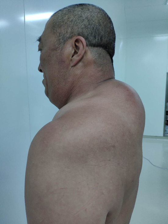 哈医大四院颈部长了大肉球当心患上罕见病马德龙病