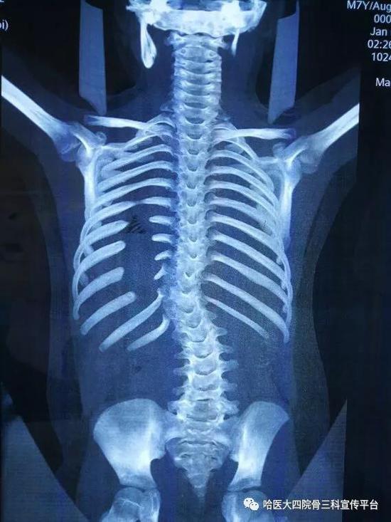 经过住院后系统的检查发现,由于脊柱侧弯,椎体旋转及特发性半椎体畸形