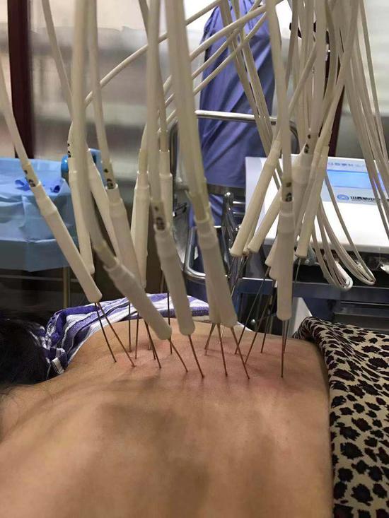 哈工大附属市一院骨外八科四次银质针助患者臀痛立减