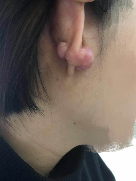打耳洞后耳朵长出"珍珠"来 原来是瘢痕体质在作怪