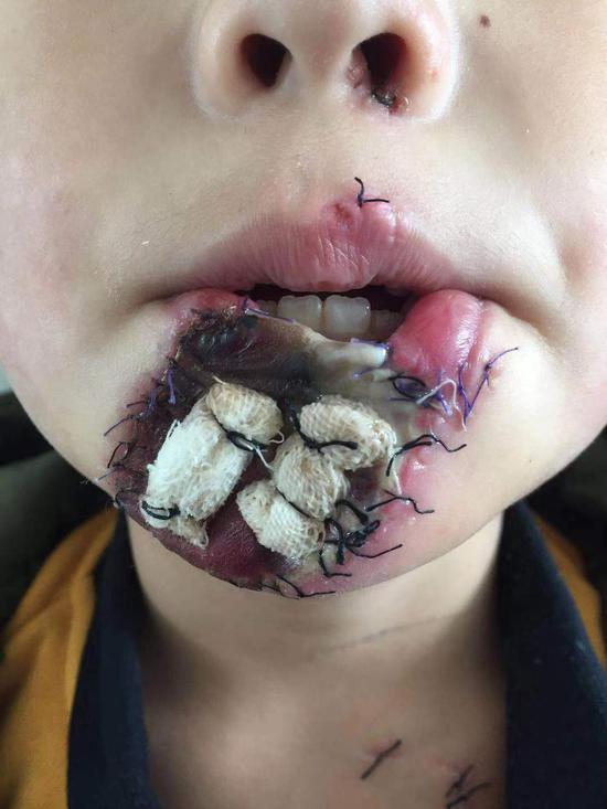 小孩嘴被针缝上的图片图片
