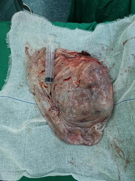 86岁老妪盆腹腔巨大囊肿术中抽取囊液达万余毫升市一院单孔腹腔镜技术