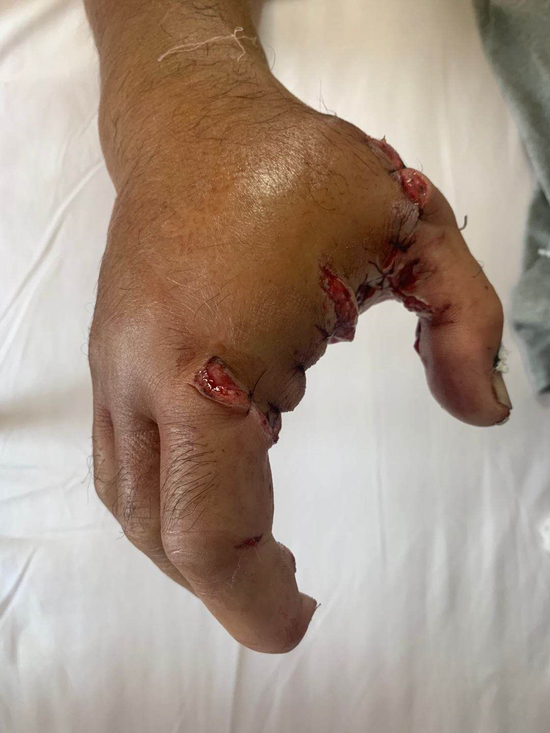 二踢脚炸耗子扎伤手指 哈市五院紧急救治保患指_新浪黑龙江_新浪网