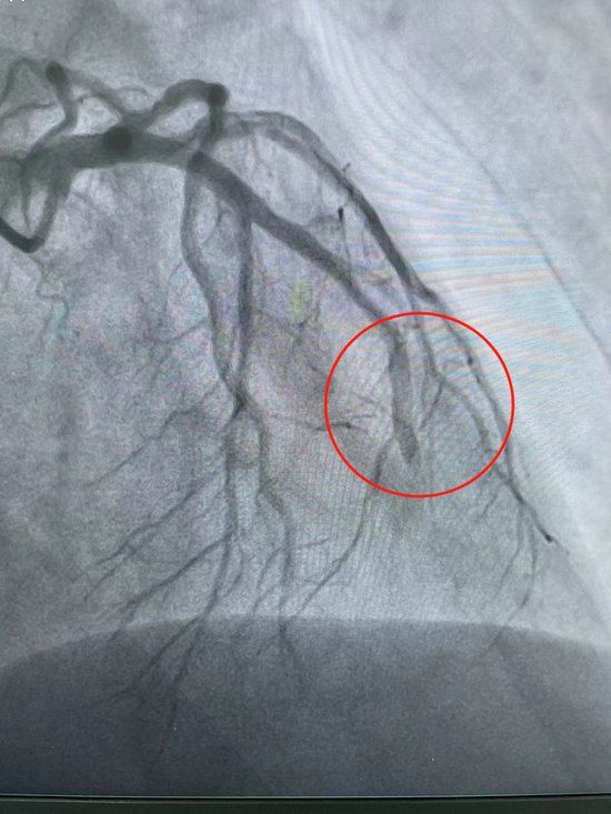 哈尔滨市第二医院双绕行与时间赛跑为患者打开生命之门