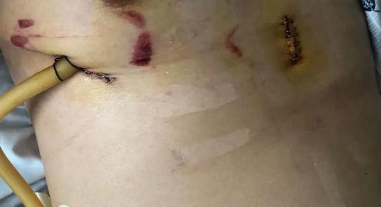 哈医大四院机器人胸部微创手术 不再刺痛肋间神经