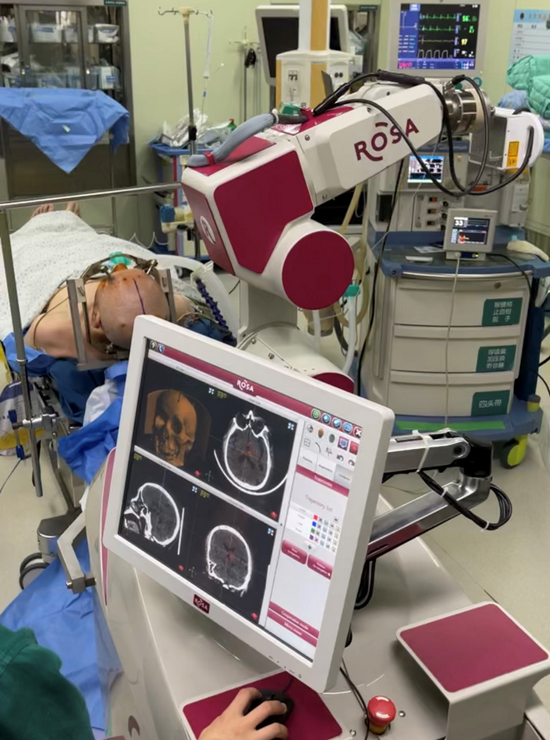 哈医大一院神外团队完成省内首例rosa机器人脑深部电刺激手术治疗肌