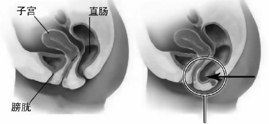 哈医大四院pph技术成功治愈重度混合痔患者