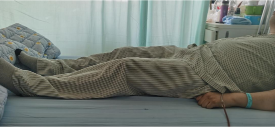 (术后正常平卧,腿已能放平)(术后正常坐及行走)