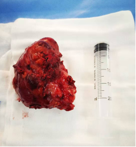 哈医大四院口腔颌面外科成功切除拳头大小颌下腺肿瘤