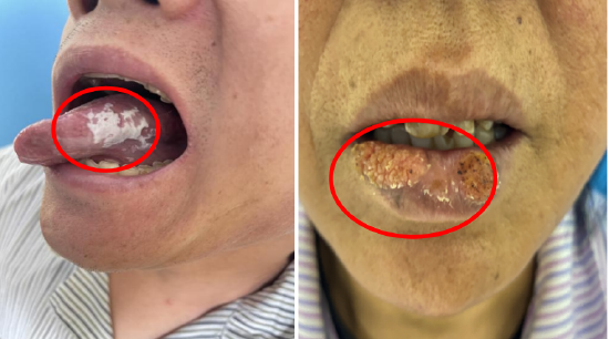 迎春节送健康哈医大一院口腔专家提示别小看口腔溃烂要小心口腔癌