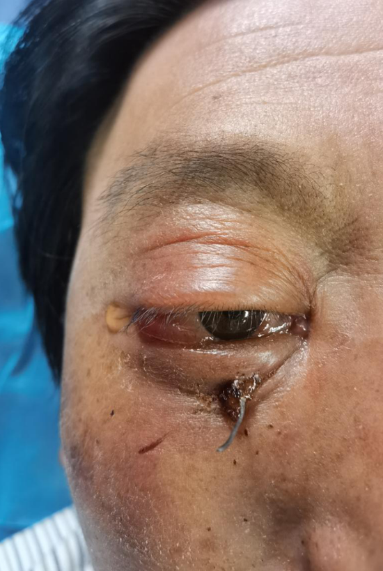 哈医大一院眼科专家提醒眼睛受伤要赶紧到医院避免二次损伤