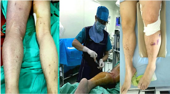 术中,术后)下肢静脉血栓(dvt)三种基本药物治疗方案黄任平教授建议