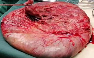 哈医大四院妇科一病房为巨大盆腔囊肿的高龄患者完成高难度手术