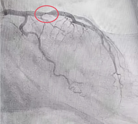 哈医大四院心内八病房巧用震波球囊治疗冠脉狭窄又钙化