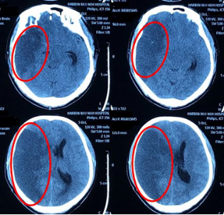 大脑中动脉栓塞导致的大面积脑梗死