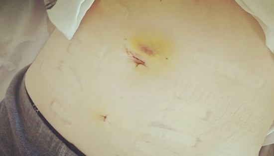 术后换药腹部情况