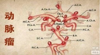 健康频道 > 正文   李利医生介绍:脑血管造影是诊断颅内动脉瘤的金