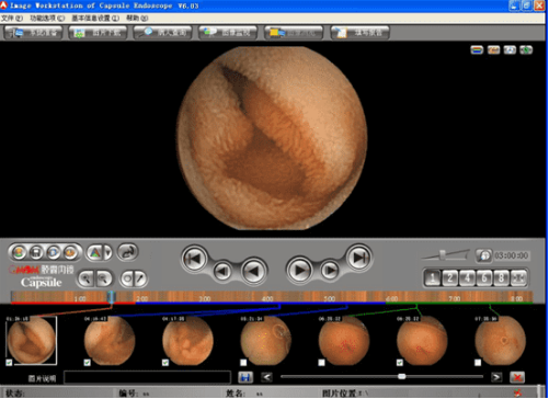 哈医大一院消化内科专家应用胶囊内镜为小肠肿瘤诊断提供精准手段