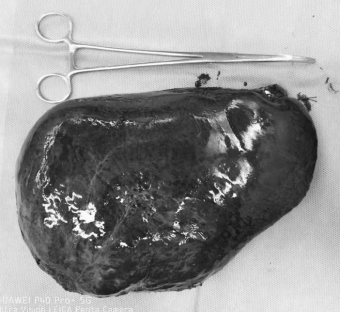 成功切除直径20厘米的肝血管瘤