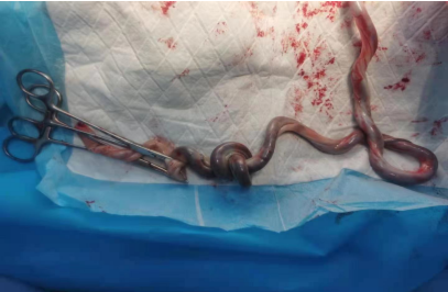 哈医大一院群力产科团队助瘢痕子宫,脐带绕颈三周真结节高龄产妇顺 