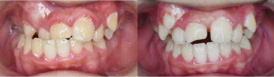 迎春节送健康哈医大一院口腔专家提示儿童牙齿不齐需要及时矫治