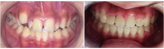 迎春节送健康哈医大一院口腔正畸专家提示儿童牙齿不齐需要及时矫治