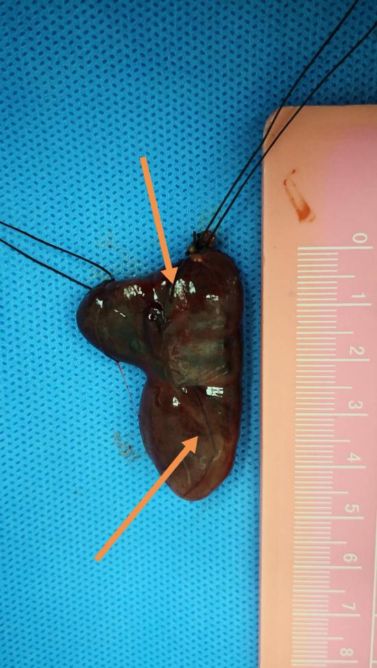 哈医大四院多学科协作诊治多发甲状旁腺腺瘤并双叶甲状腺癌患者