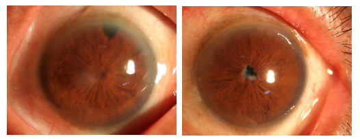 患者术前双眼前段照相