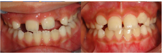 迎春节送健康哈医大一院口腔正畸专家提示儿童牙齿不齐需要及时矫治