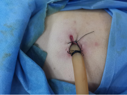 龋齿拖延不治导致胸里都是脓哈医大四院胸腔镜微创治疗亚急性脓胸