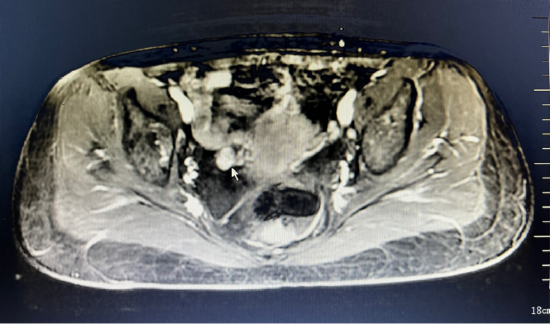 盆腔增强核磁见右侧卵巢占位