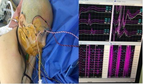 电生理监测下的右侧面神经微血管减压术
