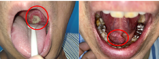 如果烧灼感,疼痛等症状超过两周仍不见好,要警惕口腔癌的可能