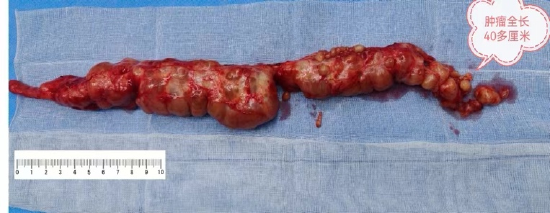 病理结果回报为神经鞘瘤.