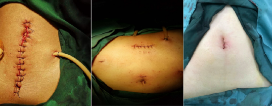 (图1)传统开腹手术 (图2)传统腔镜手术 (图3)单孔腔镜手术