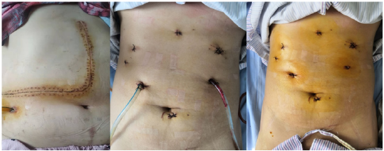 哈医大一院肝脏外科微创切除累及下腔静脉15厘米巨大肝血管瘤