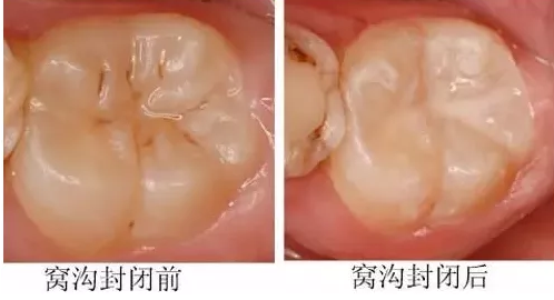 窝沟封闭是指不损伤牙体组织,将窝沟封闭材料涂布于牙齿咬合面,颊舌面