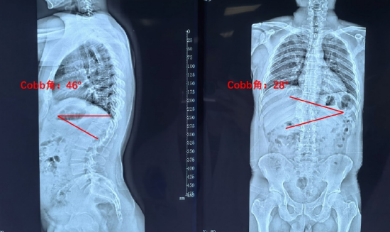 术前全脊柱全长x线正侧位示 胸椎后凸cobb角46