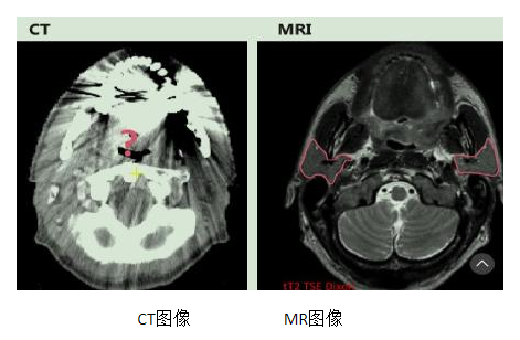 ct与mr图像上腮腺的解剖对比
