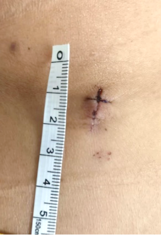 就可解决颈椎病痛哈医大二院完成多例颈椎后路脊柱内镜下的钥匙孔手术